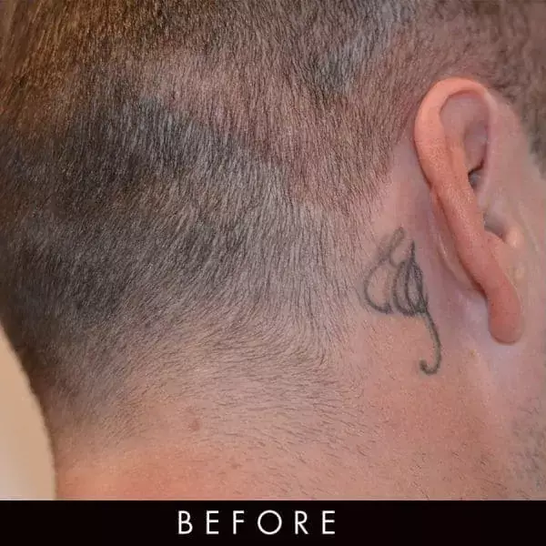 What Is Laser Tattoo Removal – And Does It Hurt? | Laser Hair Removal Dublin  Ireland | Havana Skin Clinic